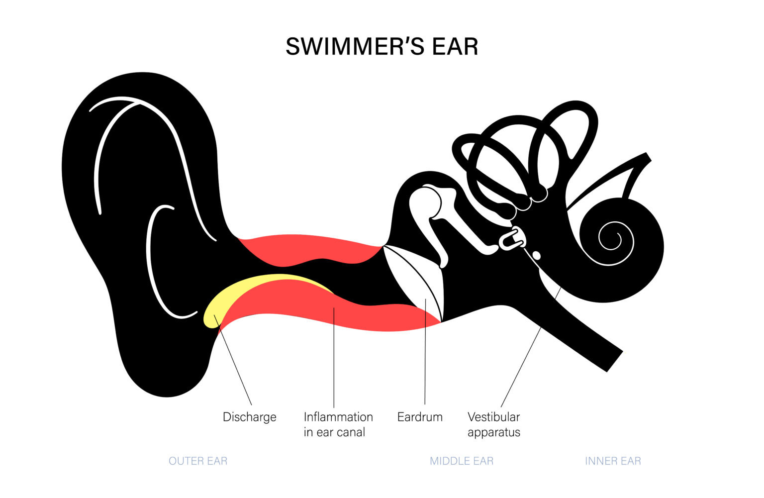 Dr siva subramanian Swimmer's ear